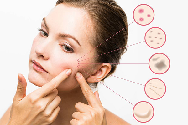Acne Treatment in HRBR Layout